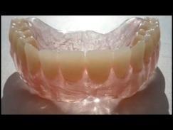 Съёмные нейлоновые зубные протезы. Плюсы и минусы